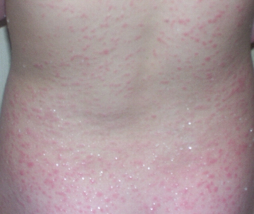 heat rashes in adults. Rash After Fever